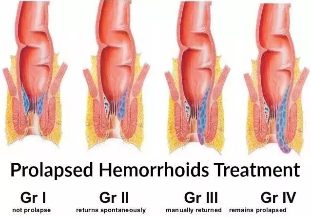 怎么判断自己是否有hpv,怎么判断自己是否有耳结石