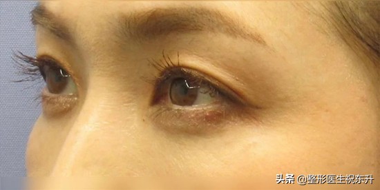 外切眶隔释放祛眼袋需要多少钱,外切眶隔释放祛眼袋真人案例