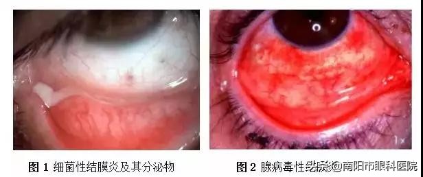 结膜炎的鉴别诊断及治疗,医生如何判断结膜炎种类