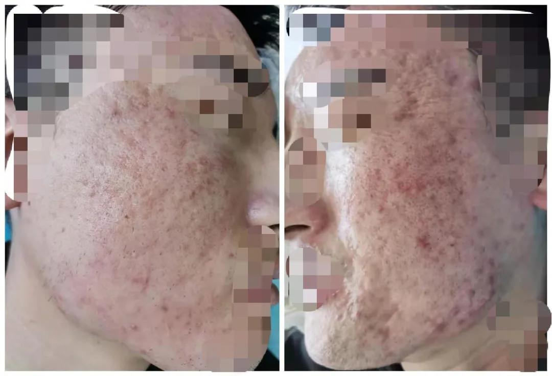 治痘疮最好的办法,战痘的最佳治疗方案