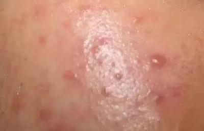 痤疮留下红色痘印痘痕怎么去除,痘印的种类区别有哪些