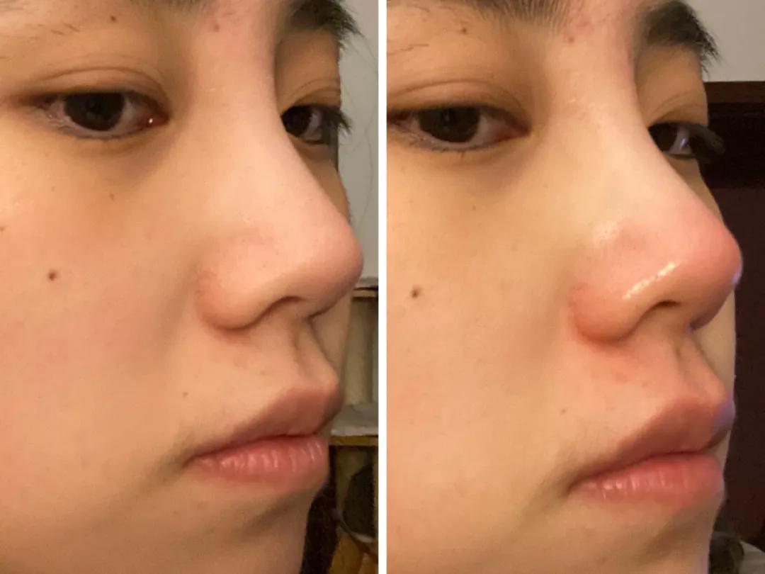 夏天露肉的季节,露肉的正确美白方法