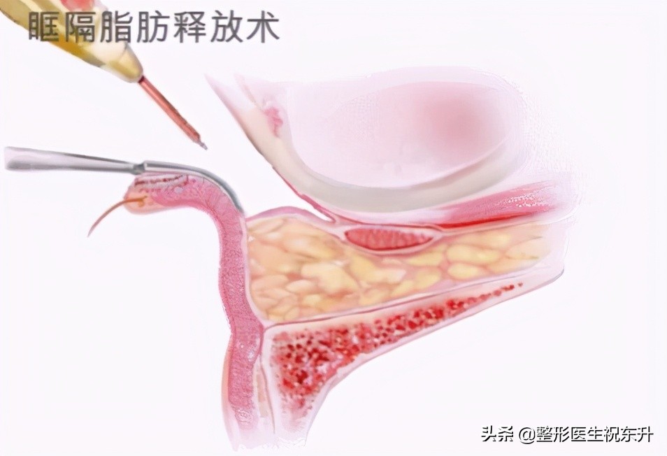 做眼袋手术的说说,关于眼袋手术的一些知识