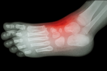 痛风治疗三剑客你了解多少,痛风分期是几期