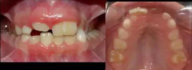 8岁宝宝牙齿长双排牙,1岁婴儿长双牙怎么办