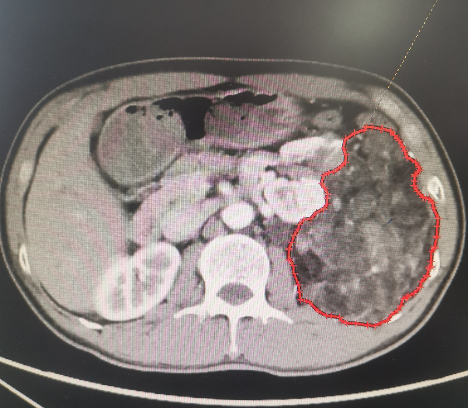 体检出肾上有个3.5厘米的瘤,肾上长个瘤子抽血检查能知道吗