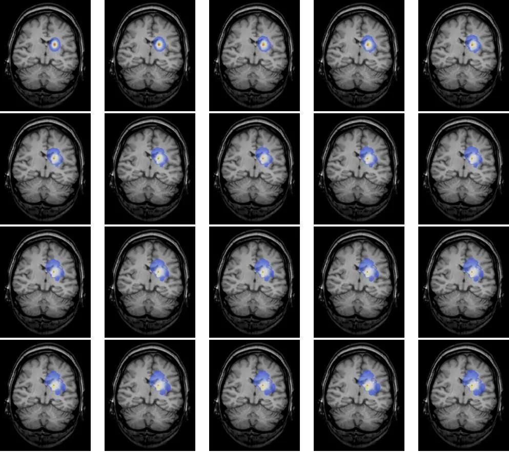 良性脑瘤一般能活多久,良性脑瘤没切干净要化疗