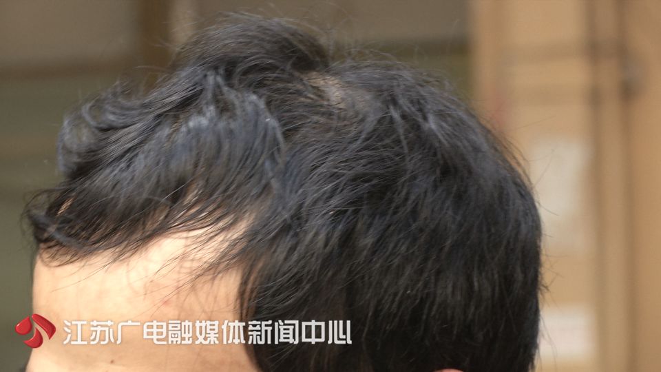 一个疗程2980,做完不掉发!小伙掏钱试了试,头更秃了!