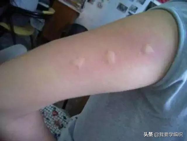 全网狂销10W+盒,日本“变态”驱蚊剂!网友:1盒搞定整个夏天