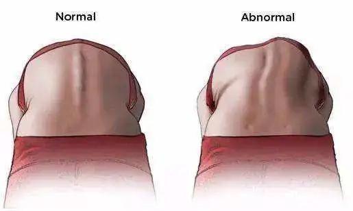 脊柱侧弯高低肩瑜伽运动矫正,瑜伽脊柱侧弯矫正器拉伸使用视频