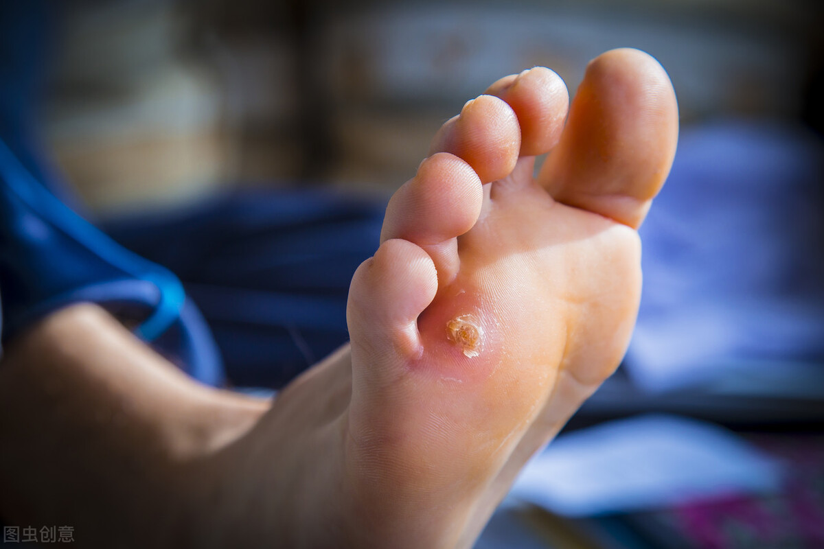 脚底长了鸡眼怎么去掉,脚底长了鸡眼不想挖怎么办