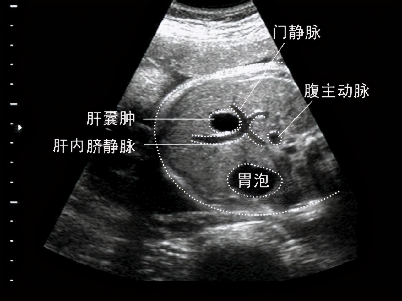 b超查出来肝囊肿要怎样治疗,肝囊肿发现有癌变时还可以治愈吗