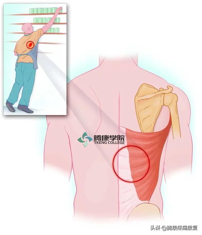 背阔肌综合征病历,背阔综合症