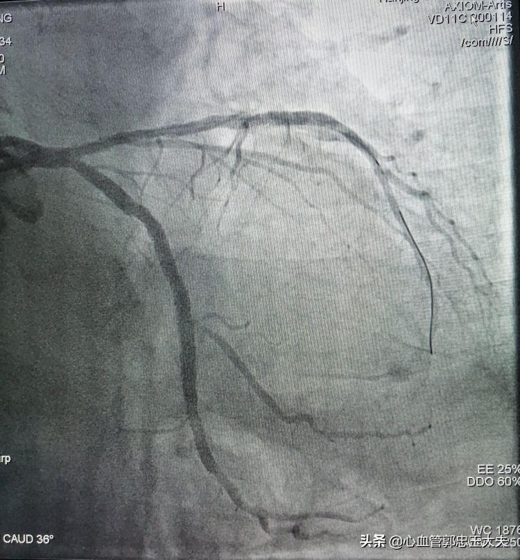 CTO遇到钙化病变怎样才能把血管打通？