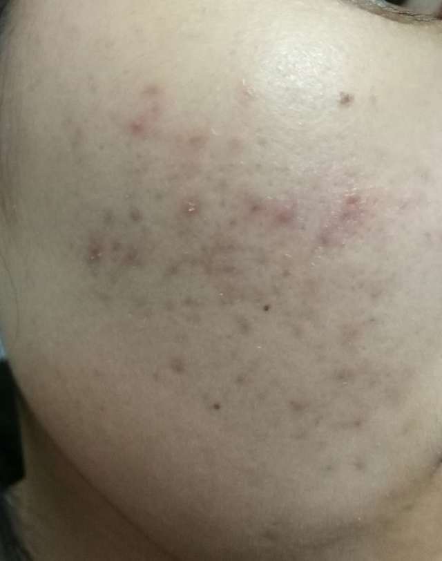 祛痘历程,祛痘经历