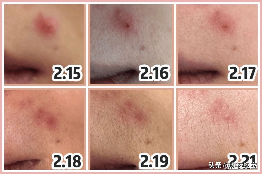 祛痘神器10元小瓶,便宜又好用的祛痘小绿瓶