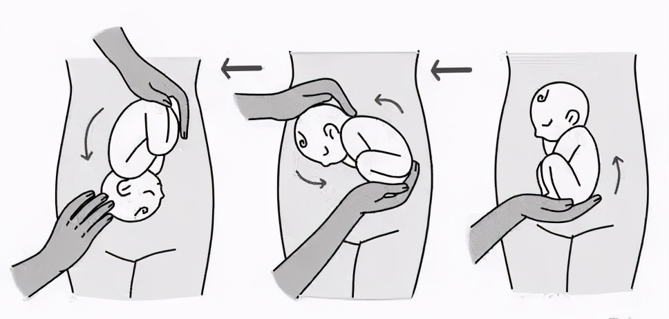 纠正胎位乾坤大挪移多少米,医生帮孕妇挪胎位