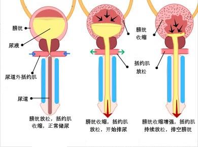 哪些疾病能导致老年病人排尿困难,前列腺疾病就是排尿困难吗