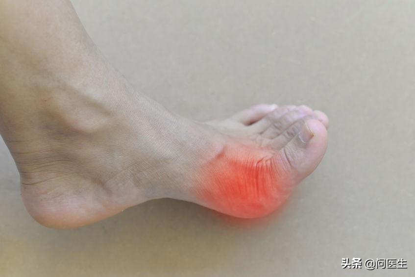 手指关节痛风症状及图片,痛风手指关节疼的最快缓解方法