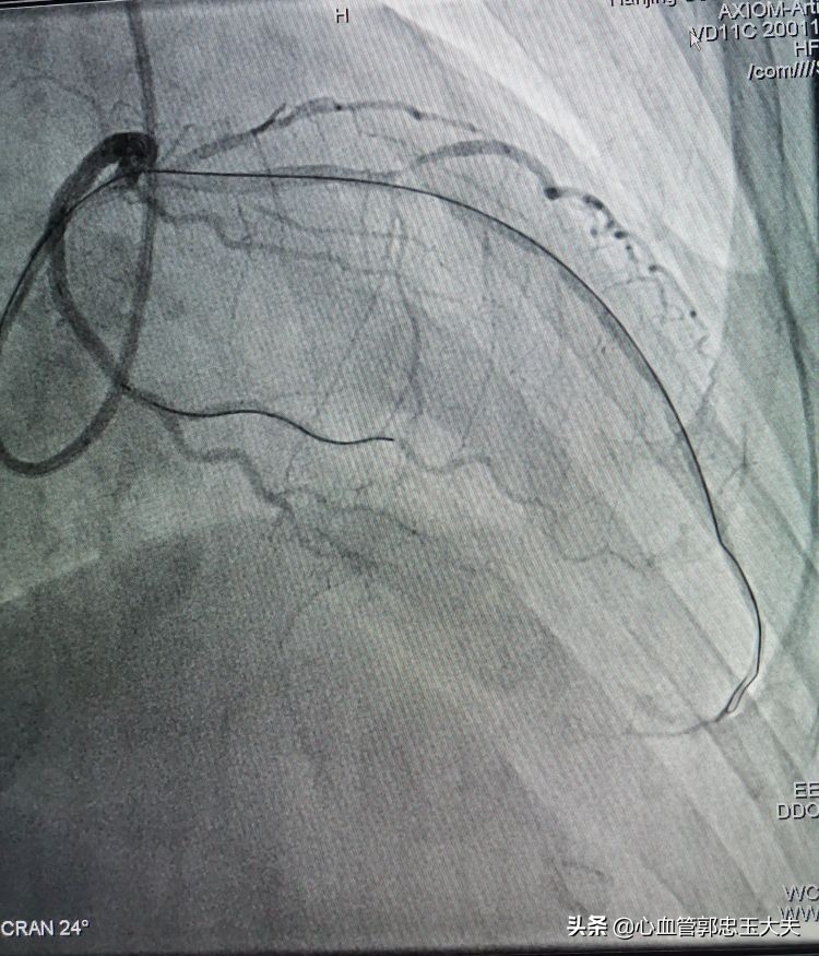 CTO遇到钙化病变怎样才能把血管打通？