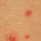 艾滋病窗口期皮肤瘙痒挠了会怎样,浑身皮肤瘙痒越挠越痒怎么解决