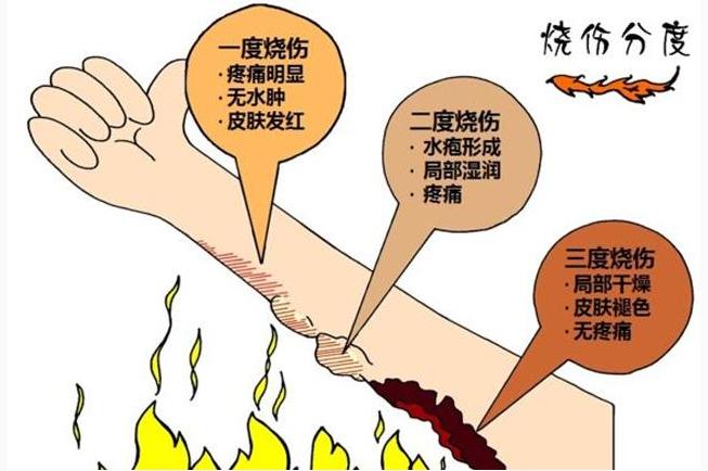 孩子被烫伤后，要先冲水还是先脱衣服？第一步做错，会加重伤情