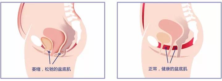 生物反馈电刺激在产后盆底肌康复的应用及效果研究