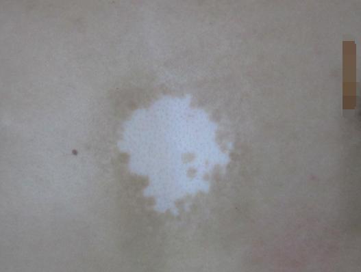 儿童白癜风发展期应该怎样控制,白癜风治愈患者分享痊愈经验