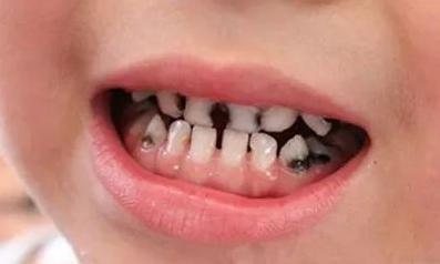 给孩子补个牙,竟花了两万多