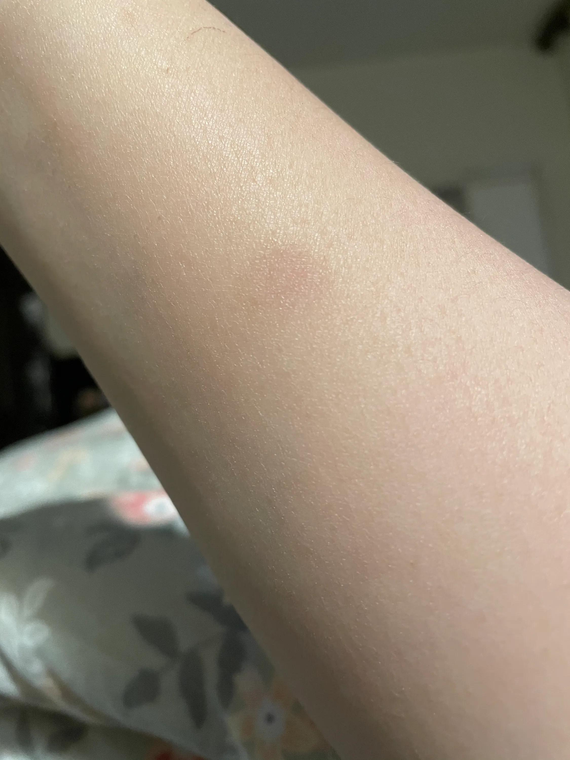 养猫经验猫得了猫癣怎么办,养猫后人得了体癣怎么办