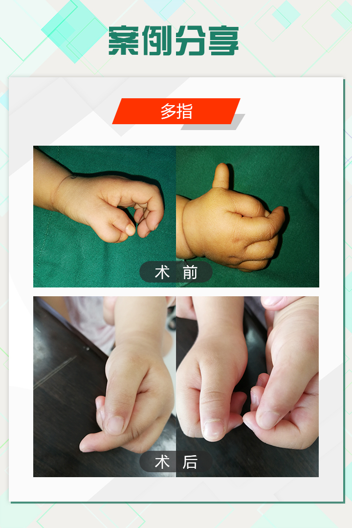 手足外科陈江海微博,手外科专家陈江海