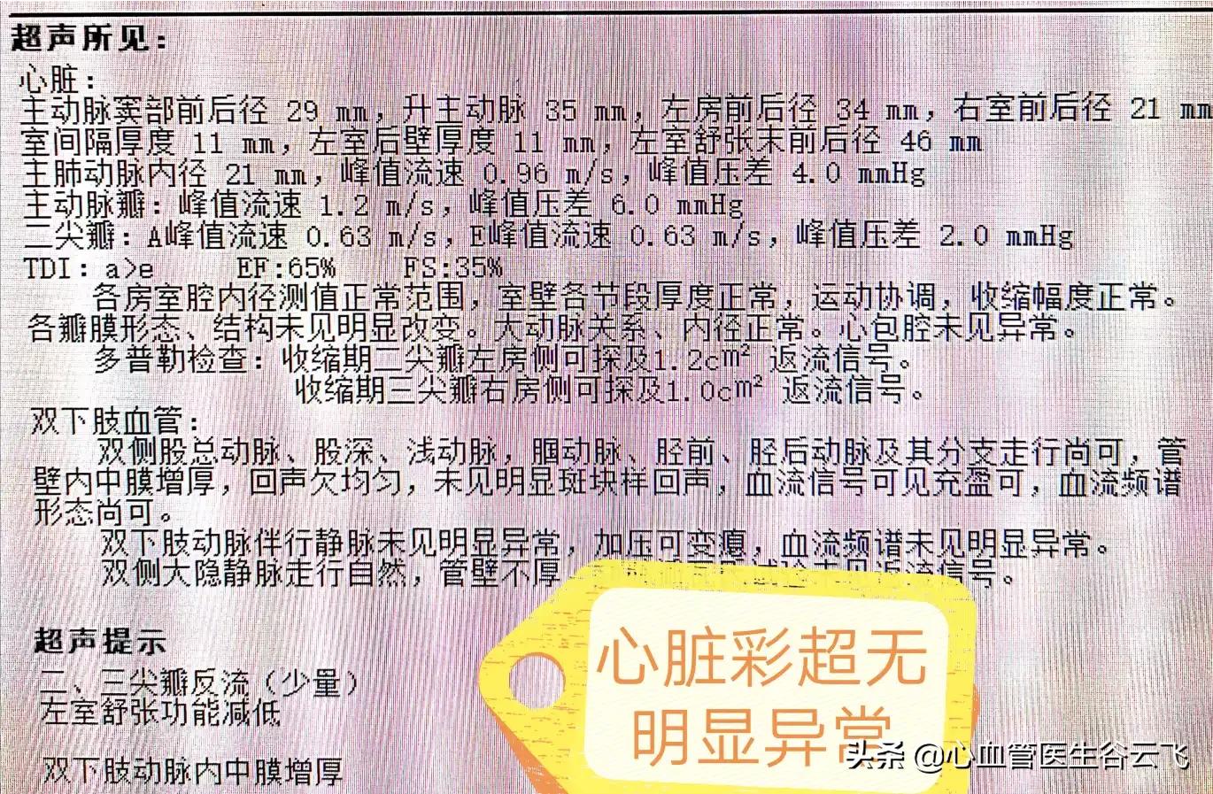 心律失常频发房性期前收缩,心律失常门诊故事