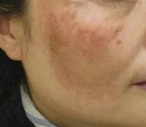 怎么区分脸上是什么斑,脸上斑怎么区分