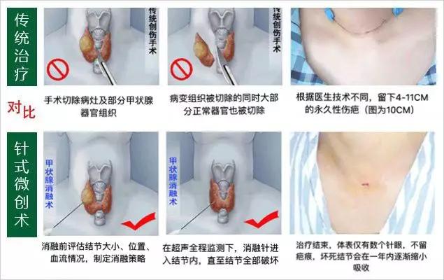 发现甲状腺结节和乳腺结节怎么办,怀孕后发现甲状腺结节4a级怎么办