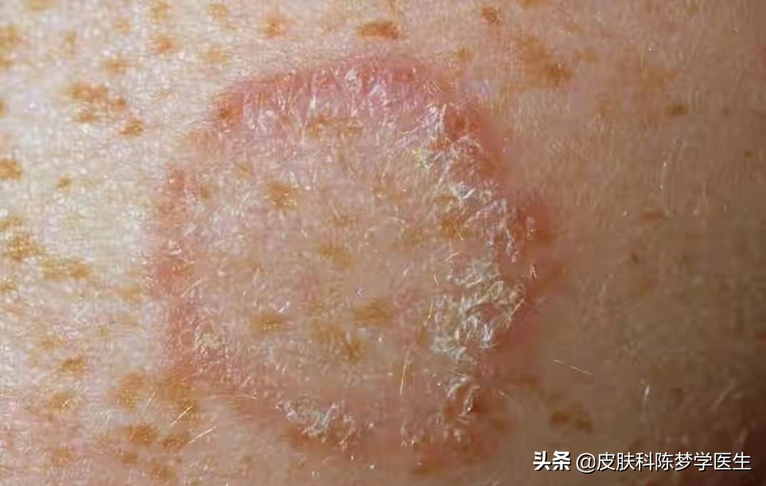红色斑块脱屑一定是牛皮癣吗,皮肤上有癣起皮颜色呈褐色