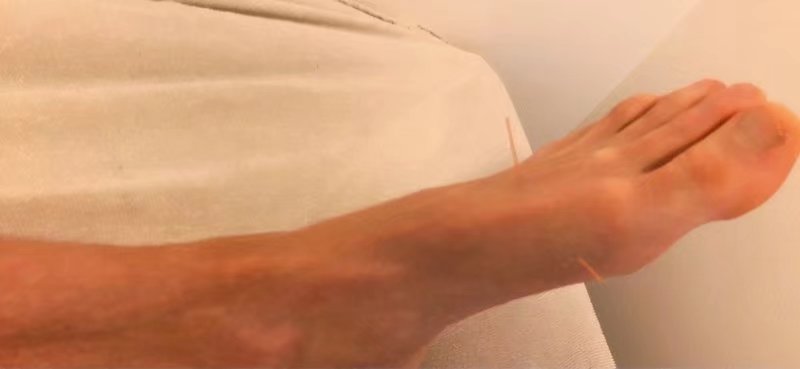 大循环治膀胱经从屁股到膝盖窝麻痛与久咳