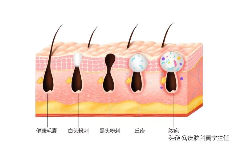 痘肌女孩必看!你想要了解的油痘肌医美项目都在这里了