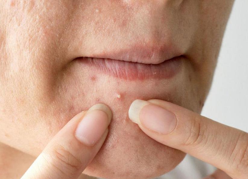 痘痘可以挤吗正确处理方法告诉你,教你正确的挤青春痘的方法