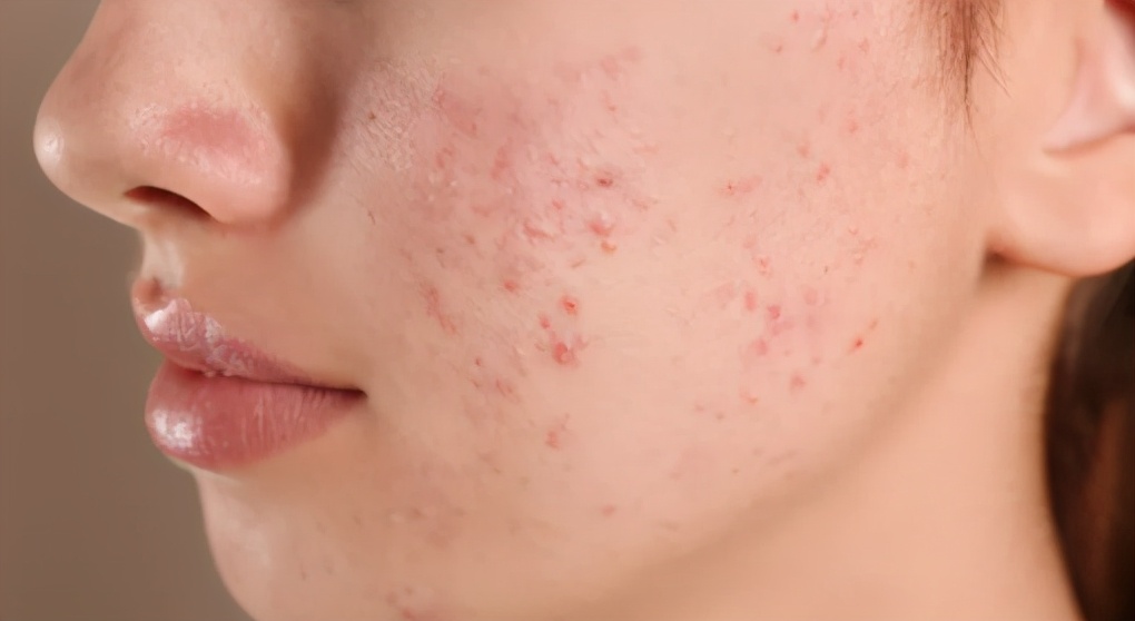 治疗痘痘的最好办法,痘痘护理的方法是什么