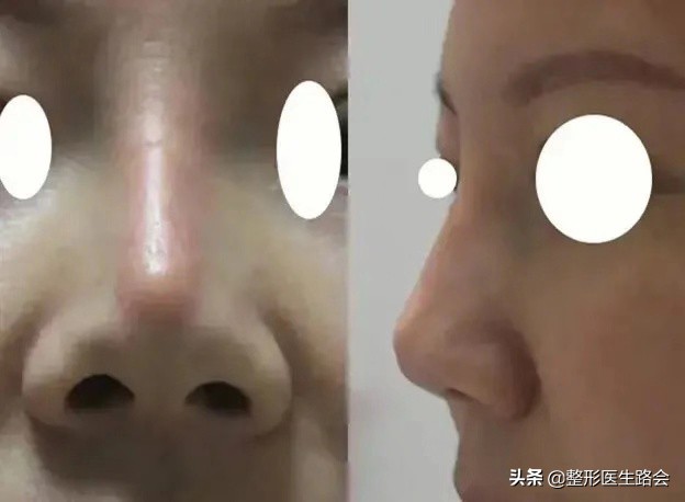 鼻子高的人正面看不是很好看,过于高挺突兀的鼻子