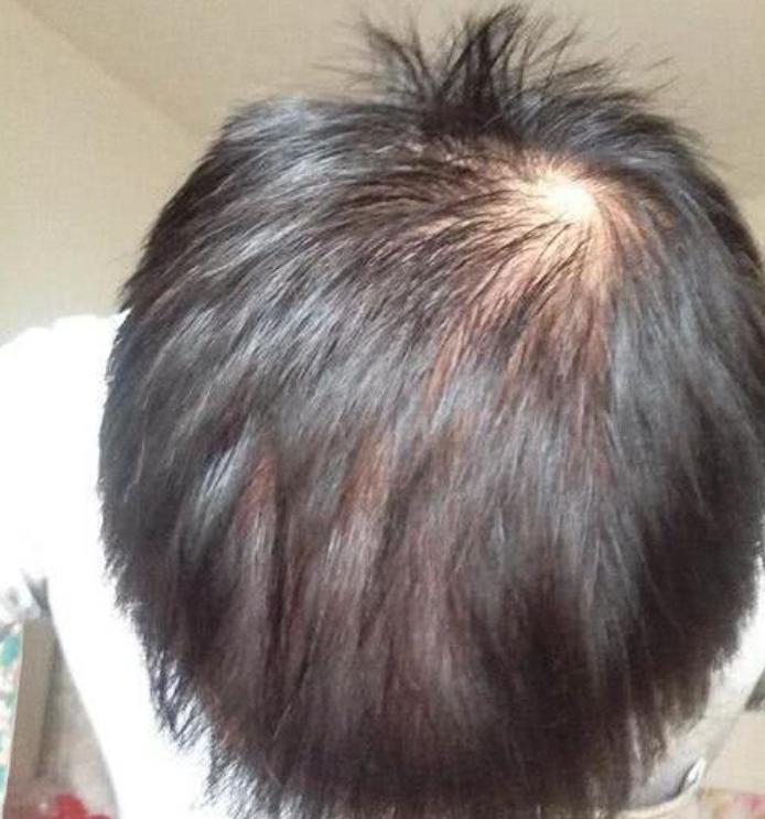 脂溢性脱发有植发的必要吗,脂溢性脱发植发靠谱吗真的有效吗