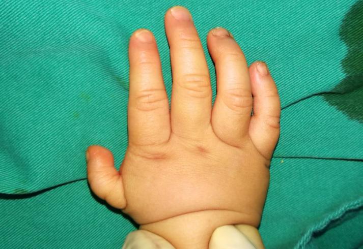 漂浮拇：成功保五指|案例5《左手多指右手漂浮拇，拇指成功搬家》