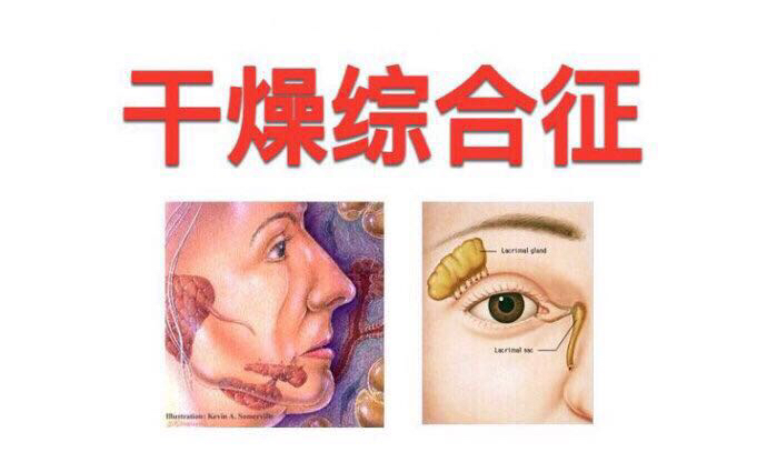 中药是如何治疗干燥综合征?