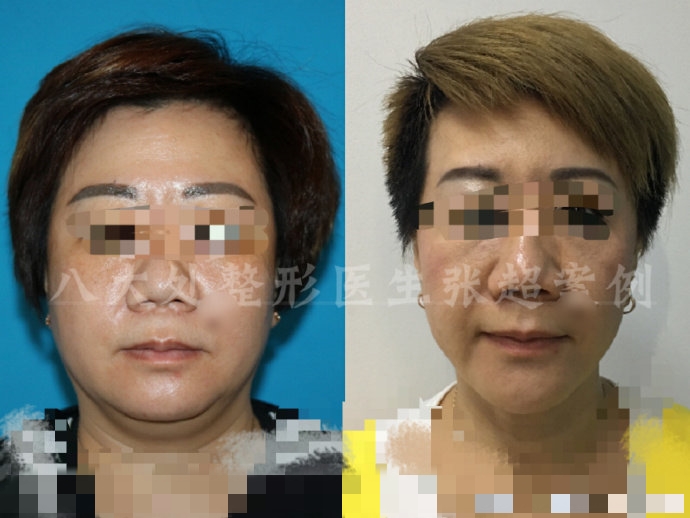 八大处整形张超,八大处张超最新视频