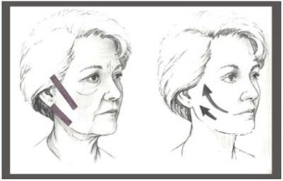 自体细胞除皱的风险,射频除皱的风险