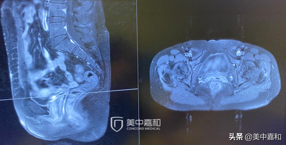 手术治疗癌症的误区,手术成功脱离生命危险
