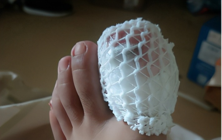 脚趾甲甲根处嵌甲怎么治疗,脚趾甲老往肉里长是缺什么吗