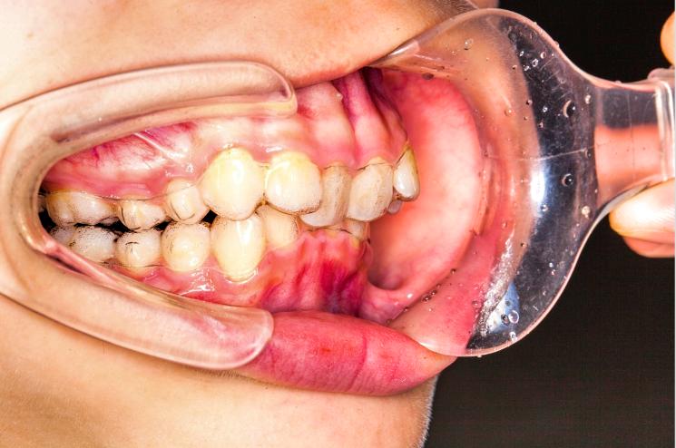 牙齿牙龈肿痛是什么原因怎么消肿,没有牙齿的牙龈肿痛怎么办