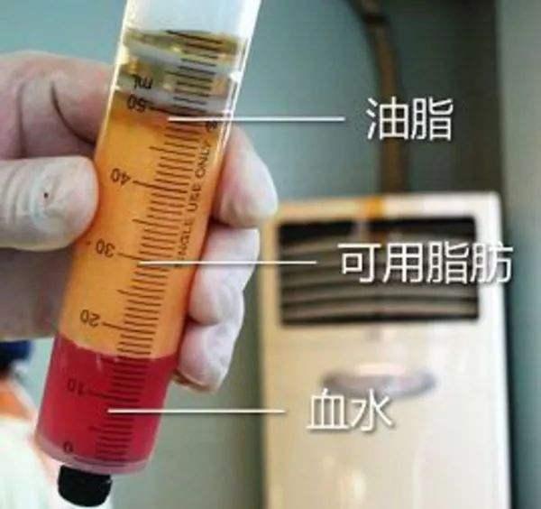 张歆艺用的什么填充脸部,张歆艺填充脸部前后对比