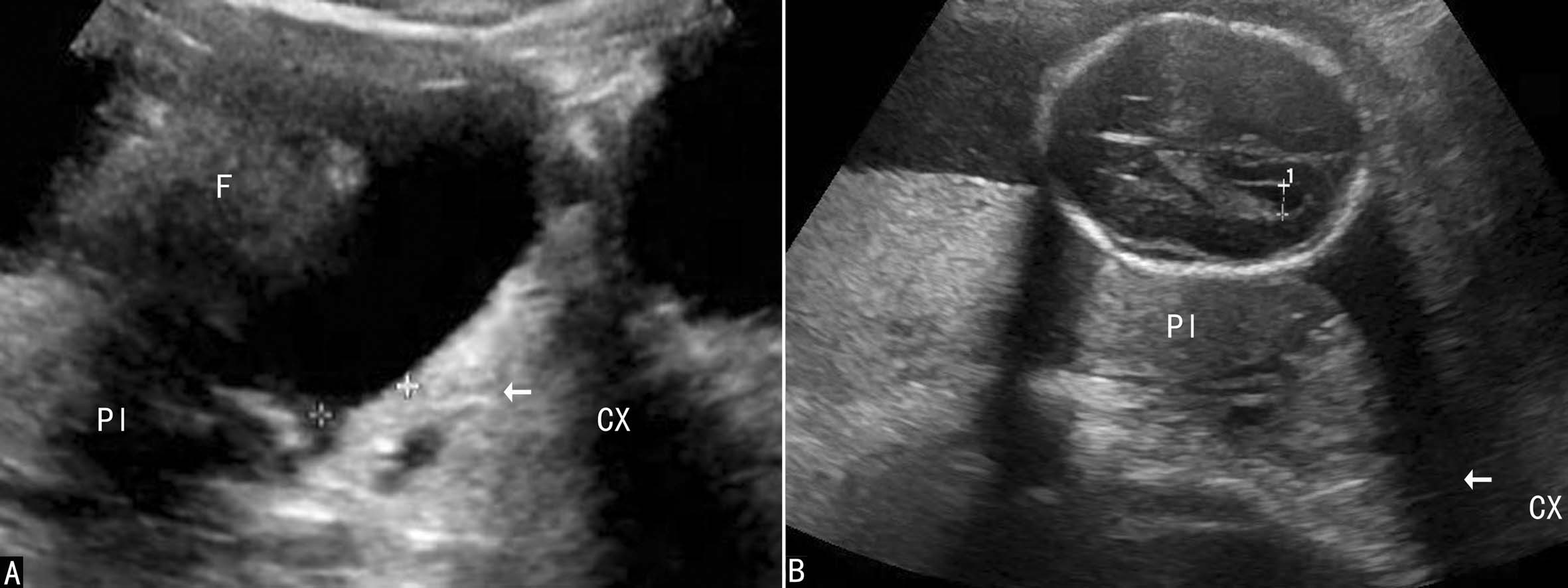 超声如何诊断前置胎盘,前置胎盘核磁报告显示胎盘无异常